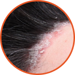 Fungal  Dandruff